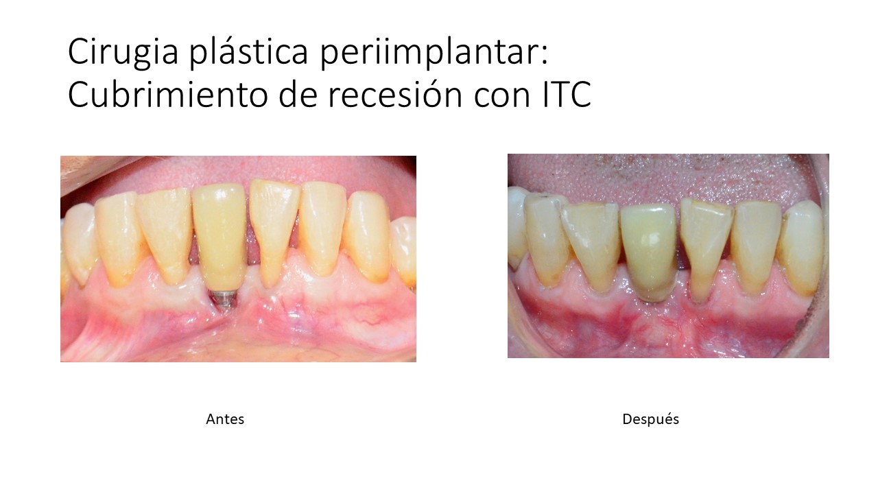 Tratramiento 3