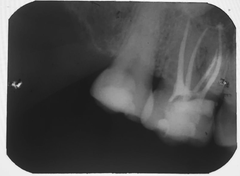 Tratramiento 3