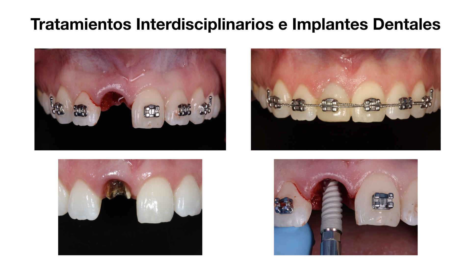 Tratramiento 4